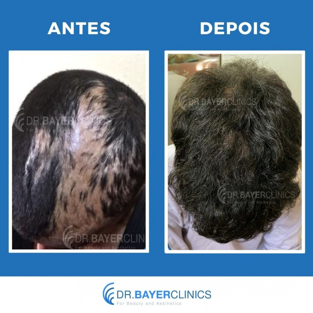 Implante de cabelo antes e depois 9