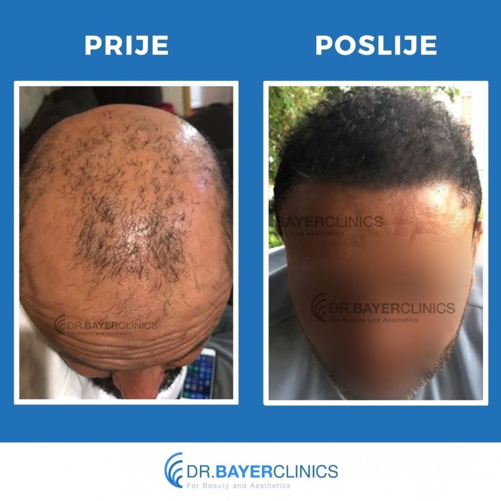 Transplantacija kose | Slike prije i poslije 9