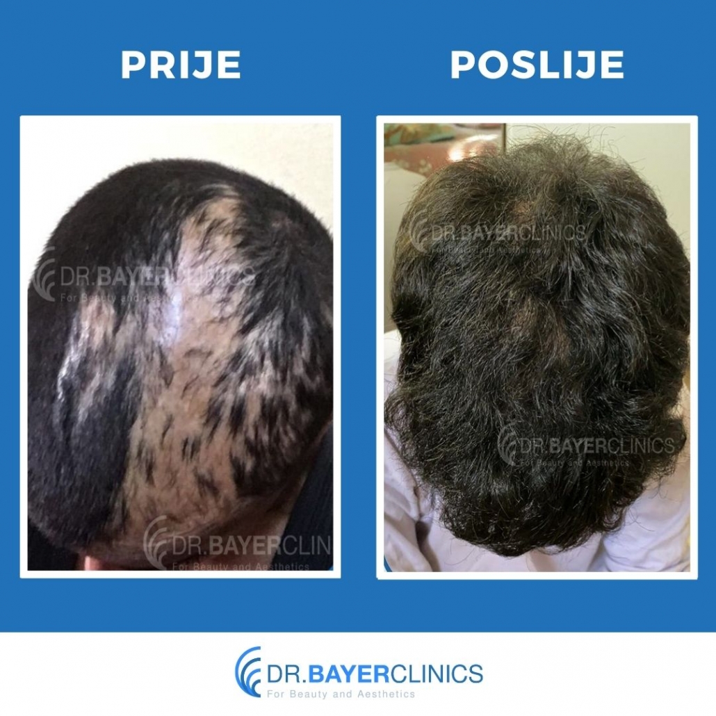 Transplantacija kose | Slike prije i poslije 4