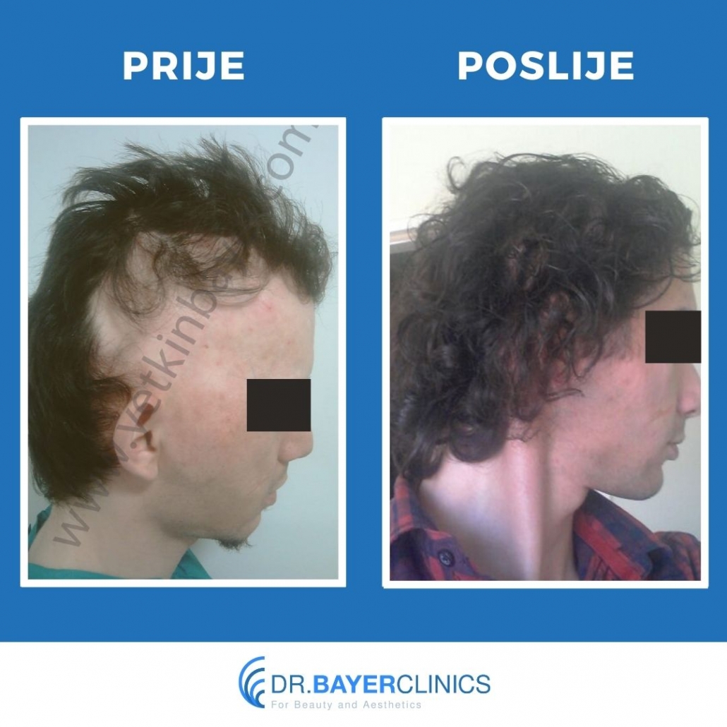 Transplantacija kose | Slike prije i poslije 7