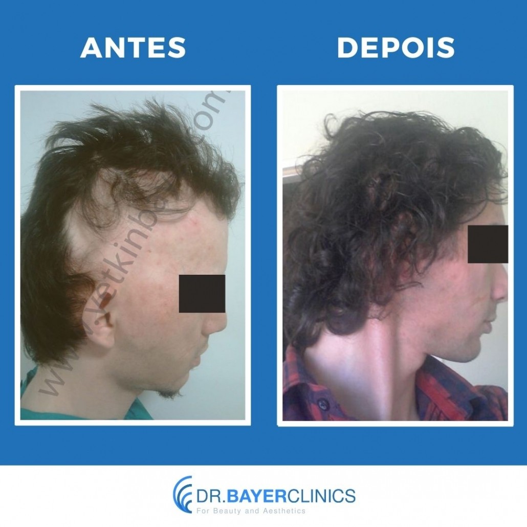 Implante de cabelo antes e depois 4