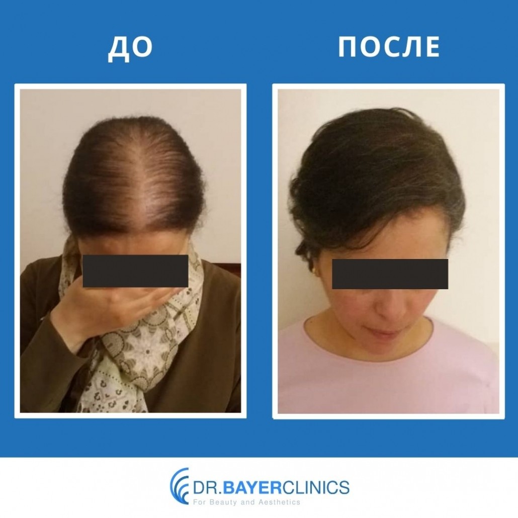 пересадка волос до и после женщины