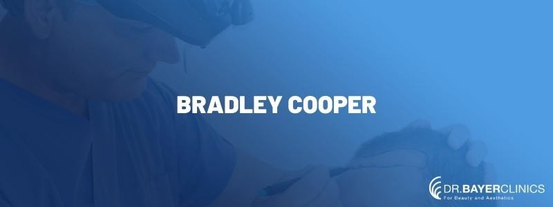 Bradley Cooper Hair Transplantation 