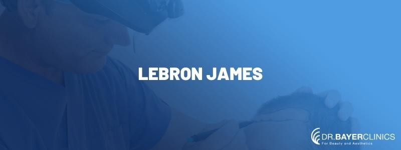  Lebron James Hair Transplant 