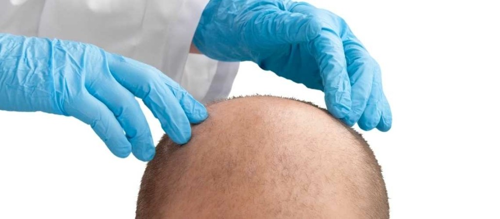 Organic Hair Transplant | Dr. Yetkin Bayer Clinics