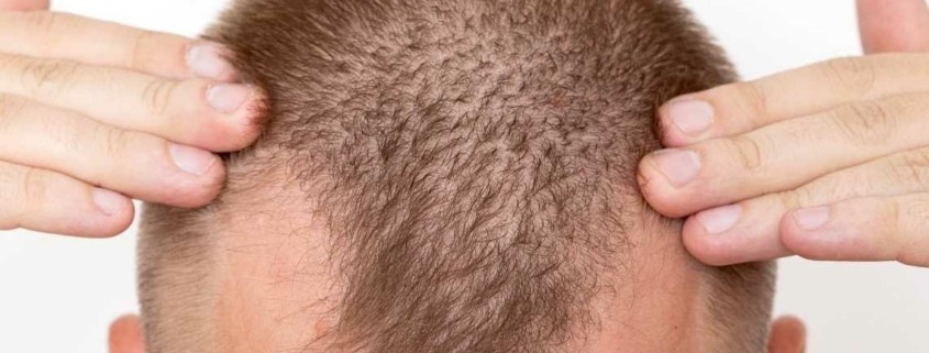 Er det det værd at få hårtransplanteret?