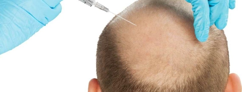 Gør hårtransplantation ondt?