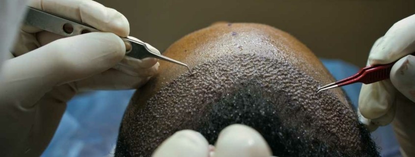 Hoe lang pijn na haartransplantatie