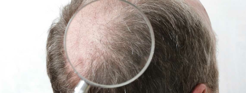 Når kan du få en hårtransplantasjon?