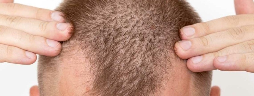 Hvor lang tid tar hårtransplantasjon?