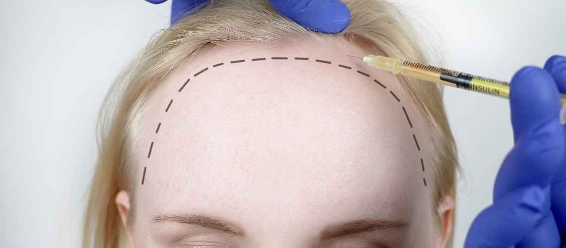 Female Hair Transplant Reviews | Dr. Yetkin Bayer Clinics