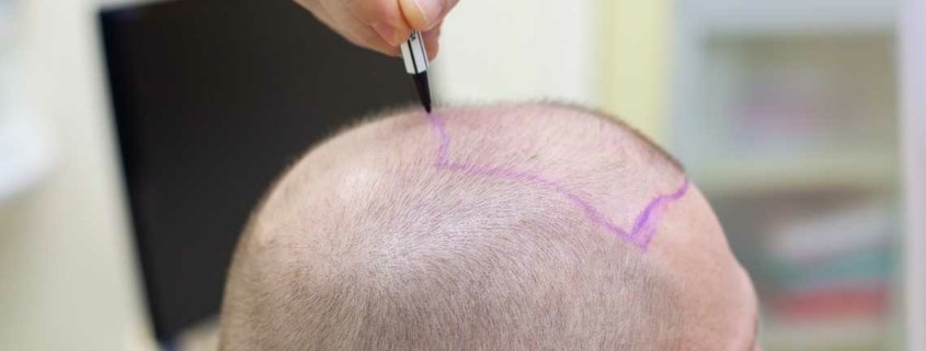 Kako dolgo traja presaditev las?