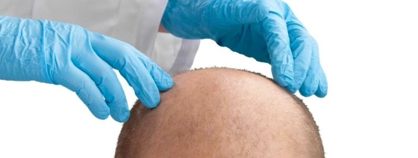 Quais são os riscos do transplante de cabelo DHI