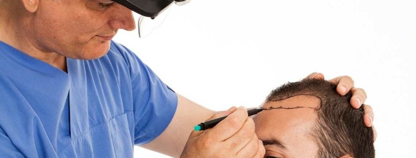 أطباء اختصاص زرع الشعر بتقنية FUT في تركيا