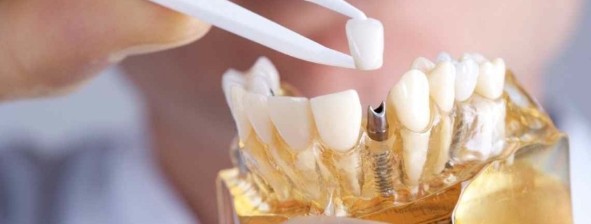 ما هي أعراض فشل زراعة الأسنان؟