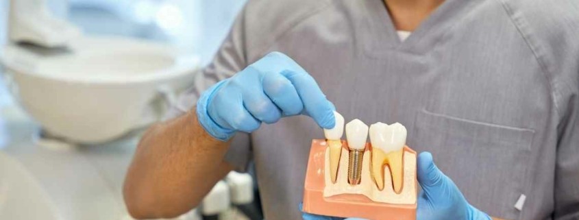 ما هي زراعة الأسنان تحت التخدير الكامل؟