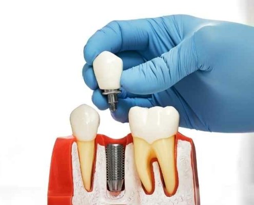 ما هي عملية زراعة الأسنان؟