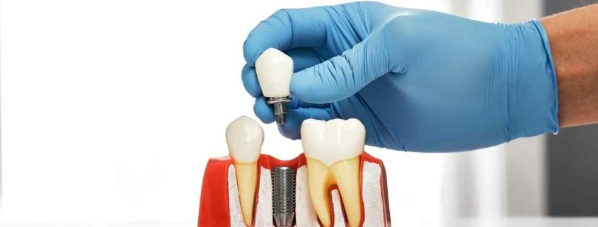 ما هي عملية زراعة الأسنان؟