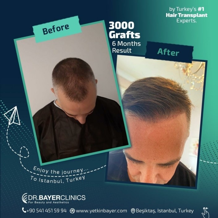 3000 Grafts Hair Transplant 6 Months Result