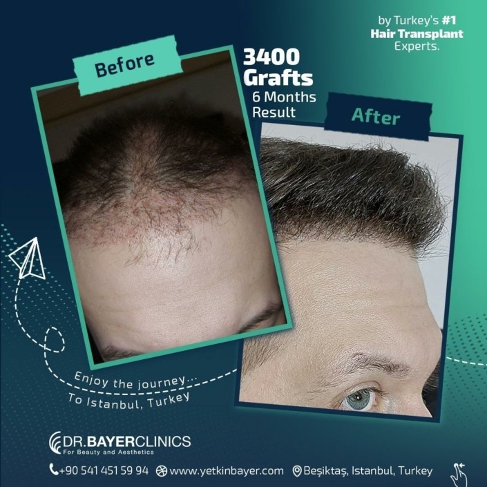 3400 Grafts Hair Transplant 6 Months Result