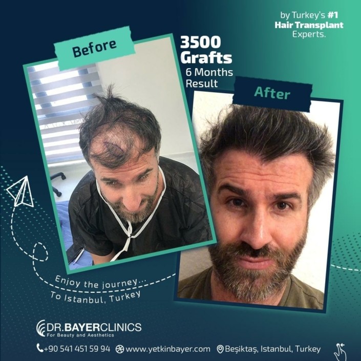 3500 Grafts Hair Transplant 6 Month Result