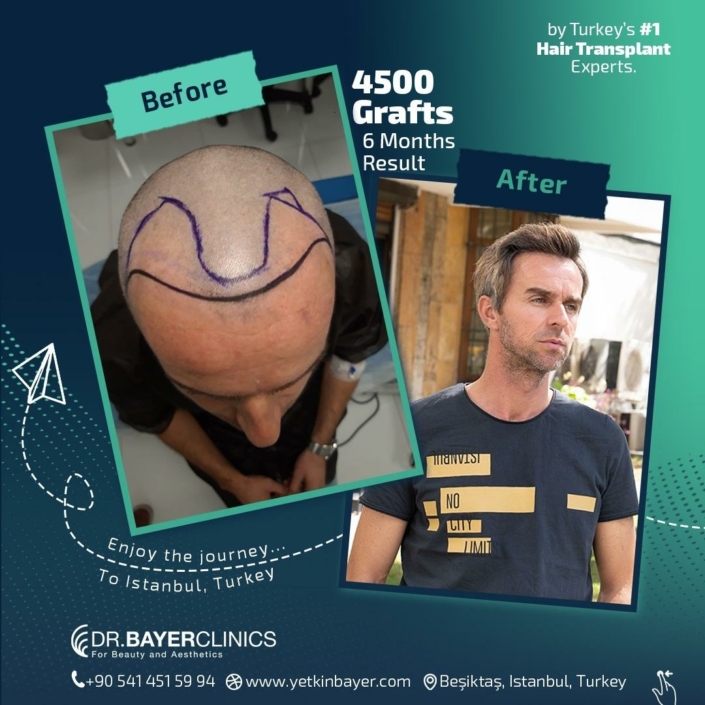 4500 Grafts Hair Transplant 6 Months Result