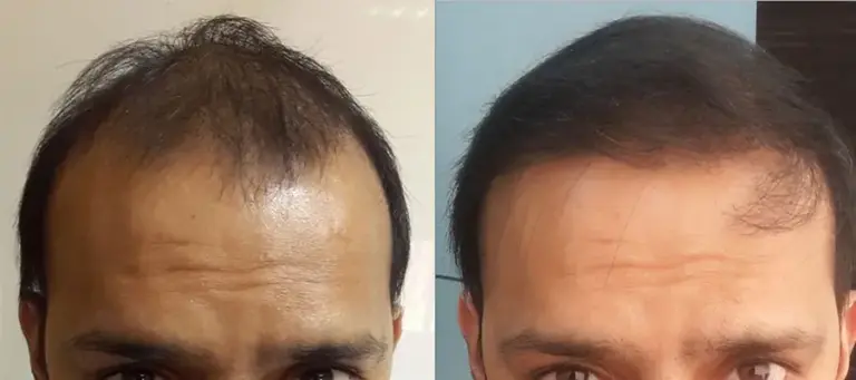Biofiber hårtransplantation