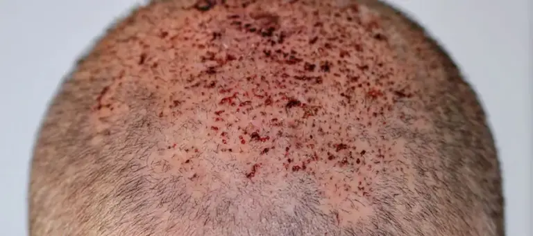 Does vomiting after hair transplant cause damage