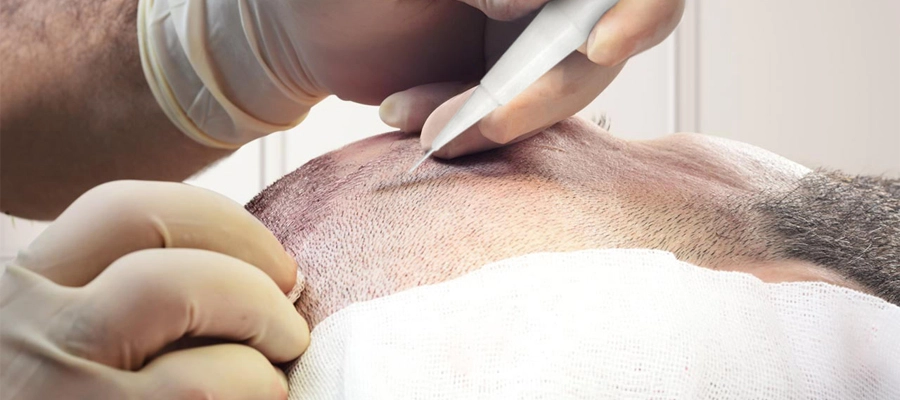 Hårtransplantation