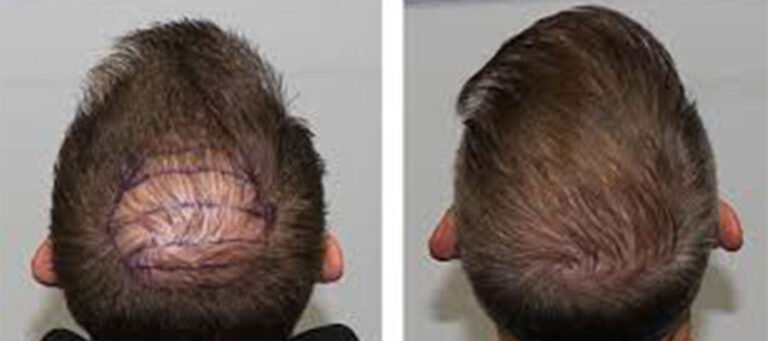 Head Trauma After Hair Transplant