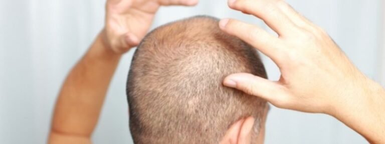 Kopf Gestosen Nach Haartransplantation