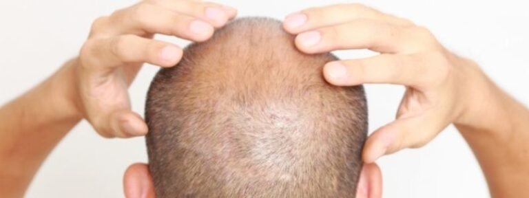 Kopfmassage nach Haartransplantation