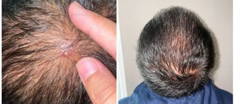 Pimples After Hair Transplant Surgery