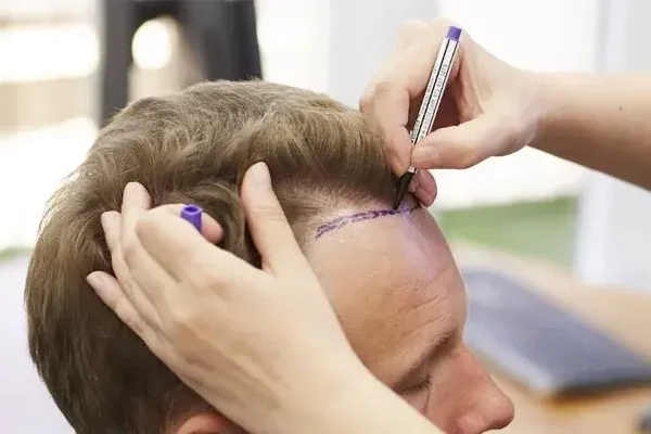 Transplantasi-Rambut-di-Turki