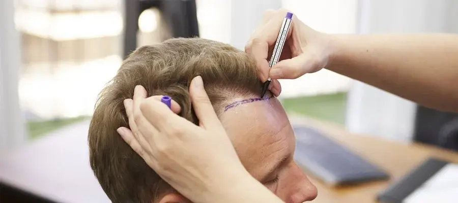 Transplantasi-Rambut-di-Turki