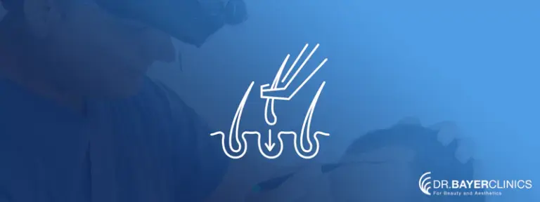 il trapianto capelli nel vertex
