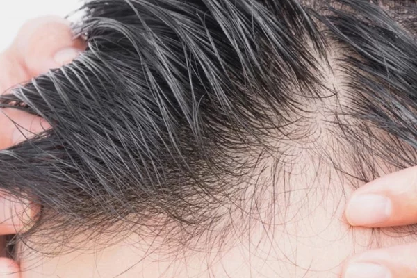 tirassiz-sac-ekimi (1)