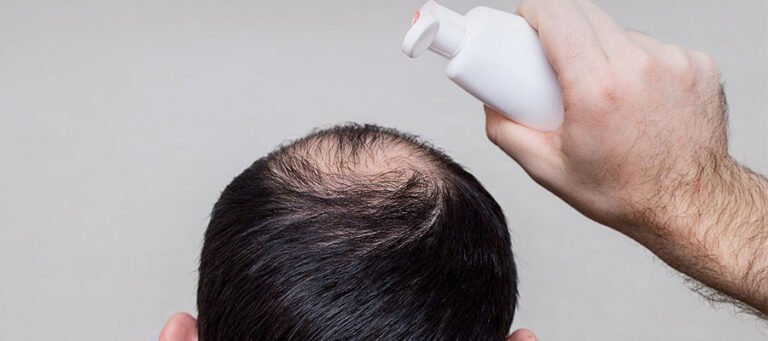 Is It Safe to Use Nizoral Shampoo after Recent Hair Transplant