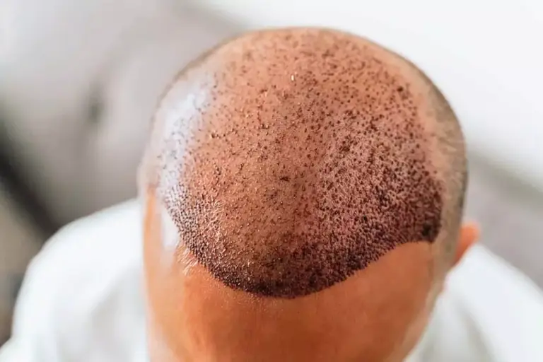 زراعة الشعر بعد 4 اشهر