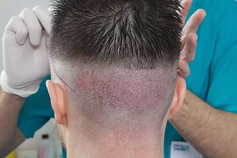 القشور بعد زراعة الشعر: متى تزول وكيفية القضاء عليها