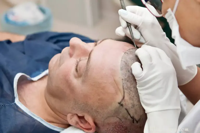  متى يزول تخدر الرأس بعد زراعة الشعر؟