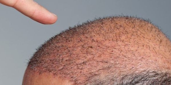 КОЖА-ГОЛОВЫ-ПОСЛЕ-ПЕРЕСАДКИ-ВОЛОС (1)