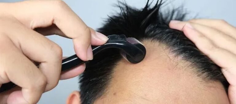Derma Roller After Hair Transplant