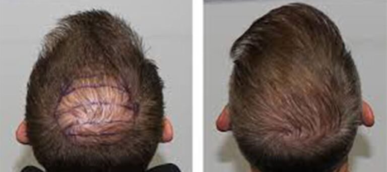 Head Trauma After Hair Transplant