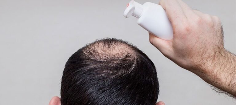 Is It Safe to Use Nizoral Shampoo after Recent Hair Transplant