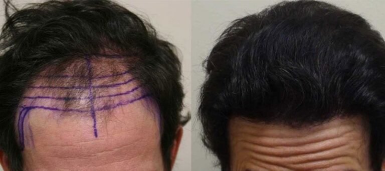 Toppik After Hair Transplant