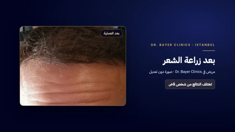 صورة دون تعديل لخط الشعر الأمامي بعد زراعة الشعر لدى مريض في عيادات الدكتور ييتكين باير