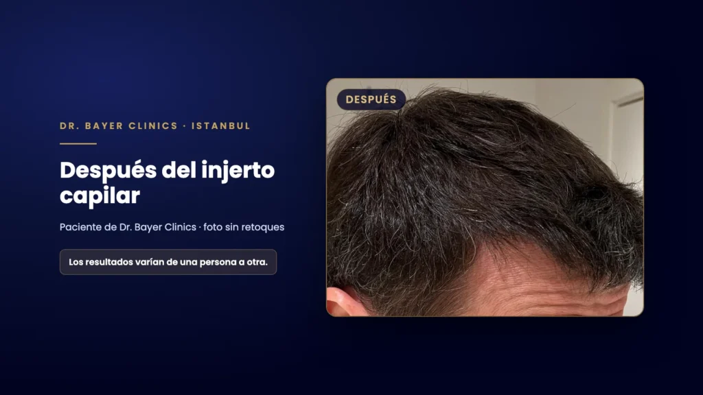 Fotografía real sin retoques de la zona frontal de un paciente después de un injerto capilar, Dr. Bayer Clinics
